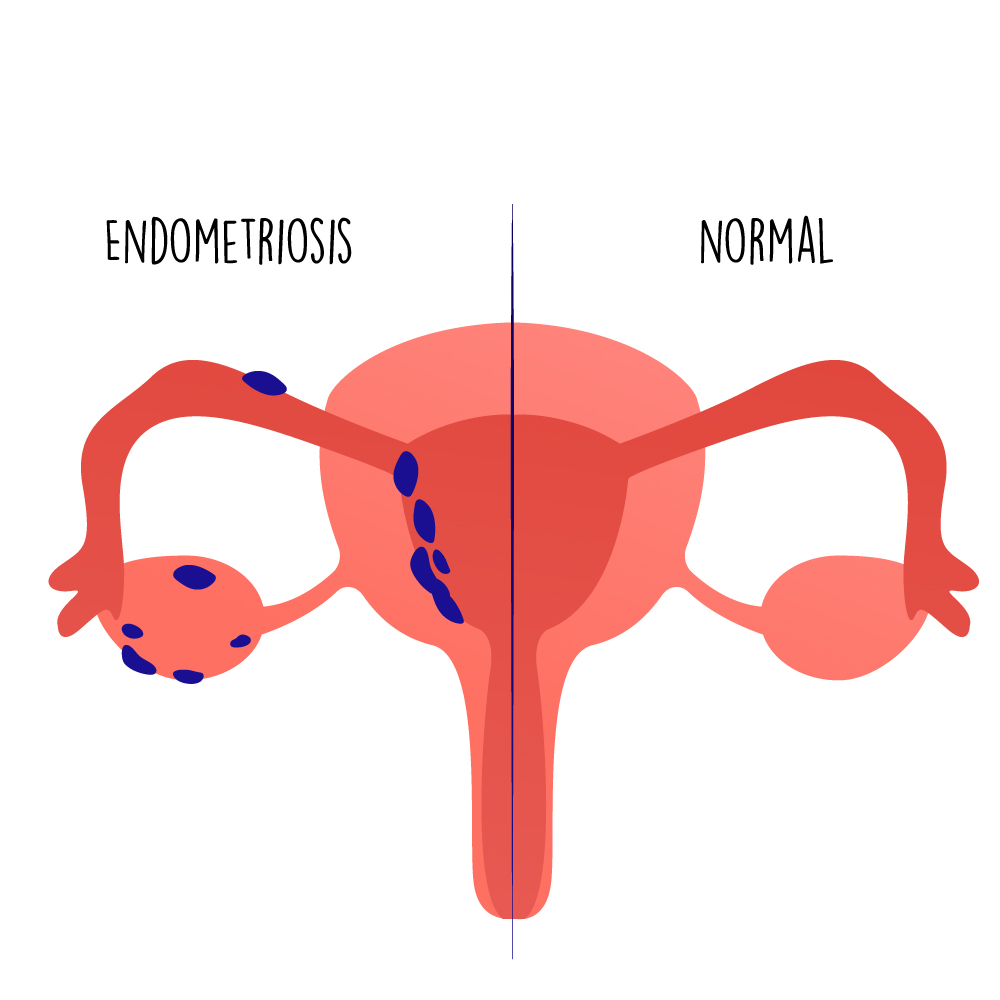 Endometriosis and everything you need to know - From the oDoc Blog