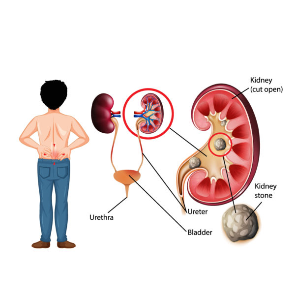 Kidney Stones : Symptoms, Causes and Treatment from the oDoc Blog